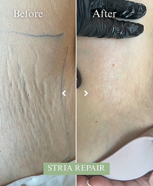 Stretch Mark Removal In Bahrain