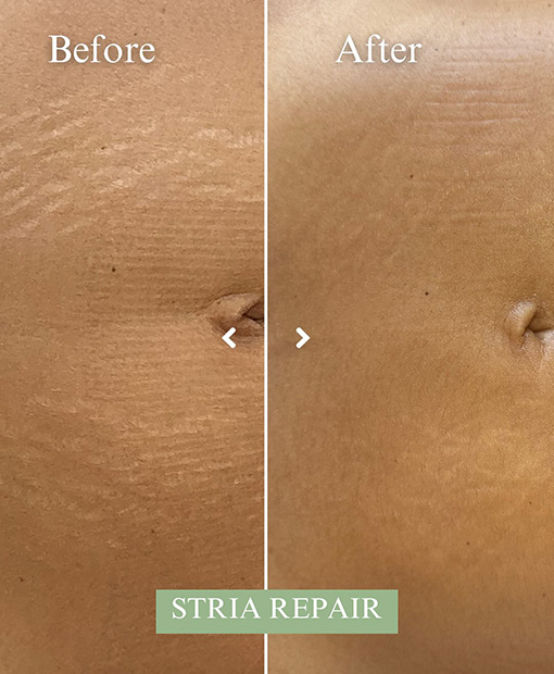 Best Stretch Mark Treatment Bahrain