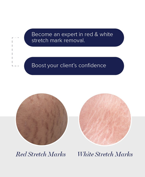 Stretch Marks Treatment Bahrain