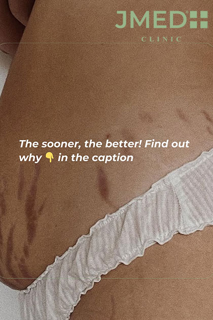 Best Treatment for Stretch Marks Best Treatment for Stretch Marks