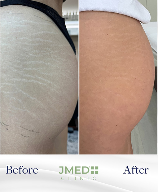 Stretch Mark Removal In Bluewaters Island