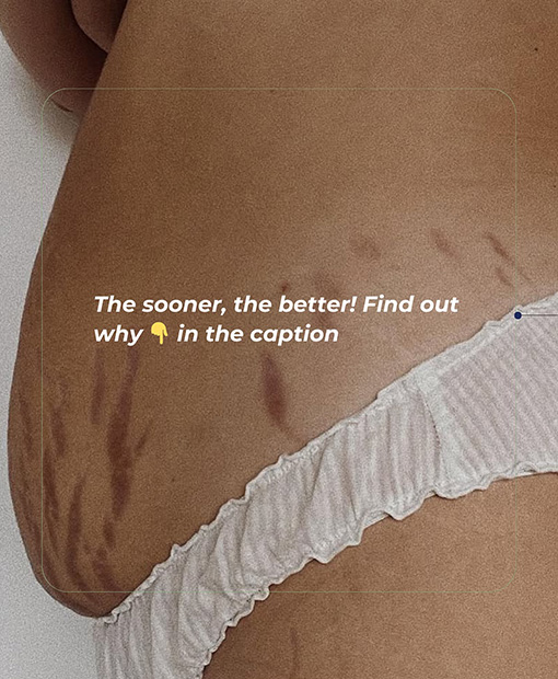 Stretch Mark Removal Clinic In Bluewaters Island