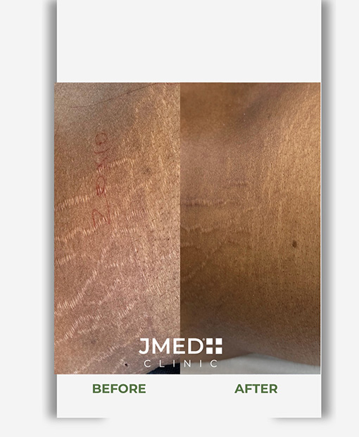 Stretch Marks Removal Business Bay