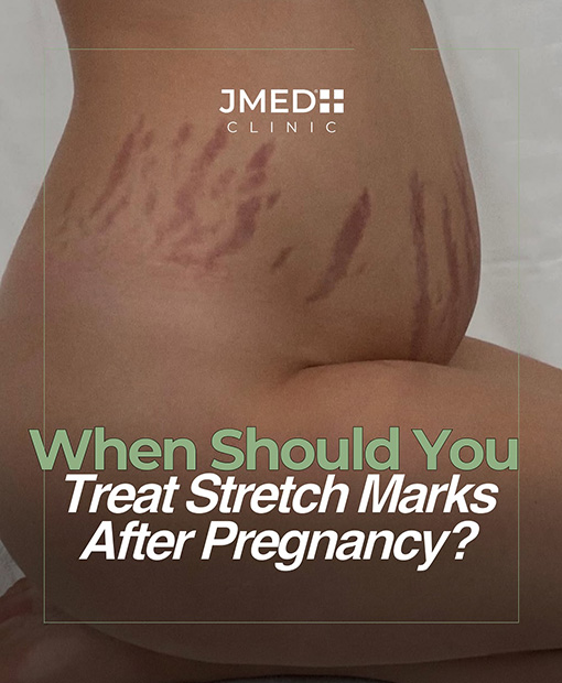 Stretch Mark Removal In Downtown Dubai Stretch Mark Removal In Downtown Dubai