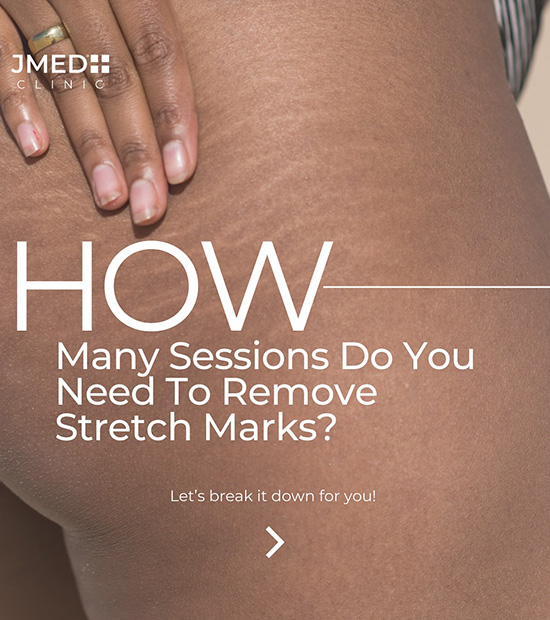 Stretch Mark Treatment Dubai Creek