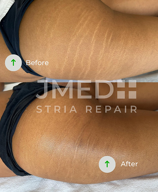 Stretch Mark Treatment Dubai Creek