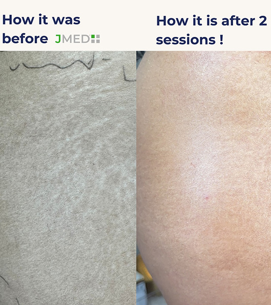 Stretch Mark Removal Clinic Dubai Hills