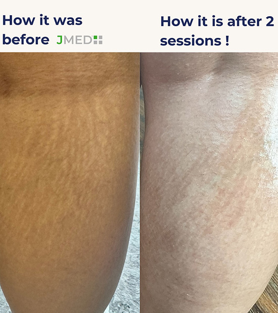 Stretch Marks Removal Dubai Hills
