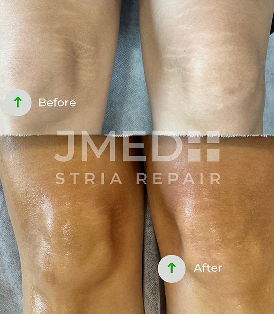 Stretch Marks Treatment Dubai Marina