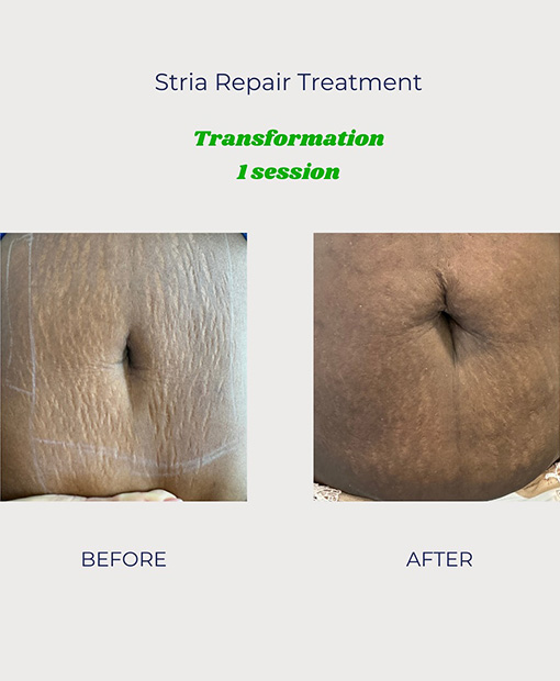 Stretch Mark Removal In Emirates Hills