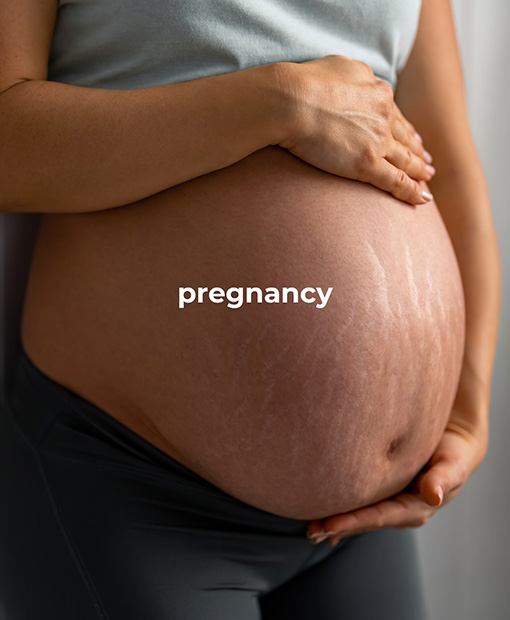 Stretch Mark Removal Clinic Emirates Hills