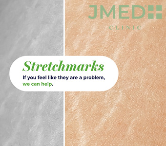 How Do I Get Rid Of Stretch Marks? How Do I Get Rid Of Stretch Marks?