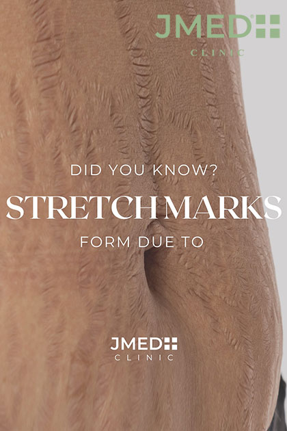 How is the Stria Repair Method a Popular Choice How is the Stria Repair Method a Popular Choice