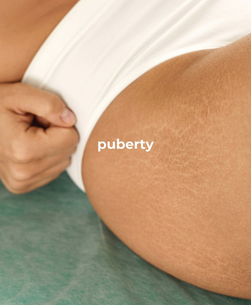 Stretch Mark Removal Clinic JBR