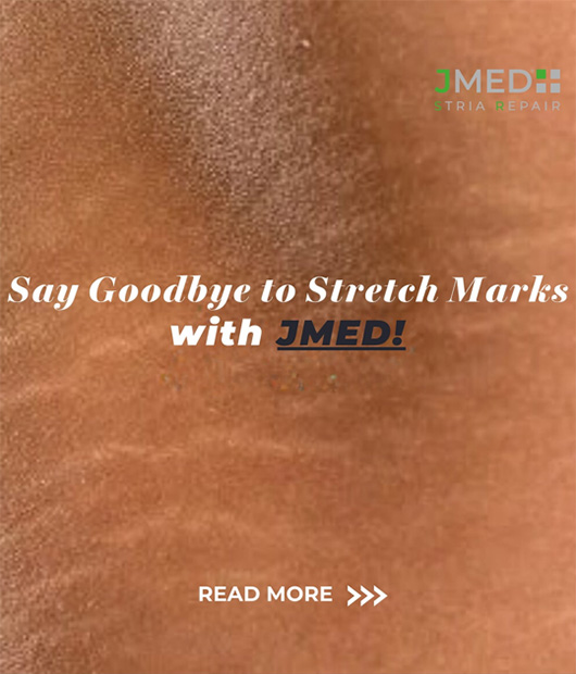 Stretch Mark Treatment Jumeirah Golf Estates