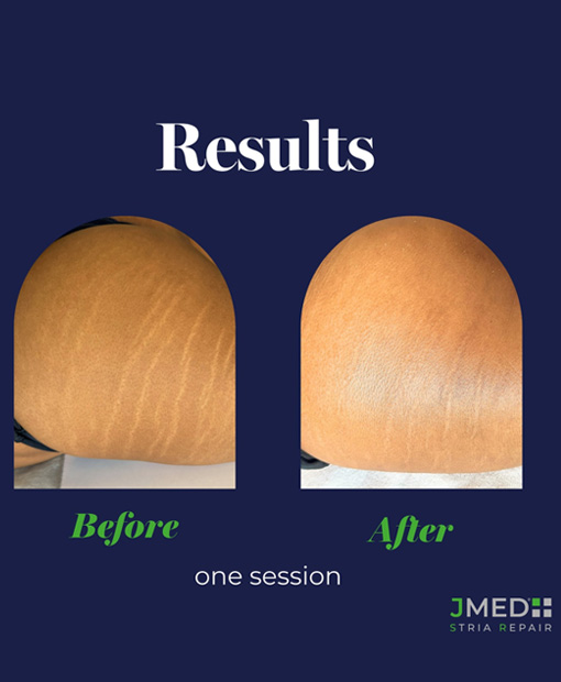 Stretch Mark Removal Jumeirah Golf Estates