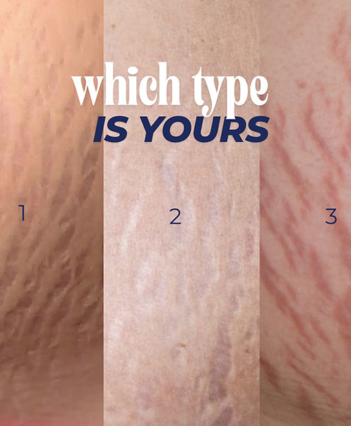 Stretch Marks Removal Jumeirah Park