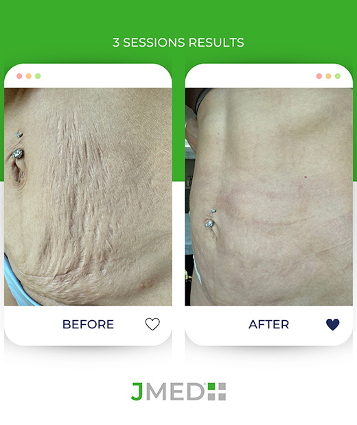 Stretch Mark Specialist Jumeirah Park