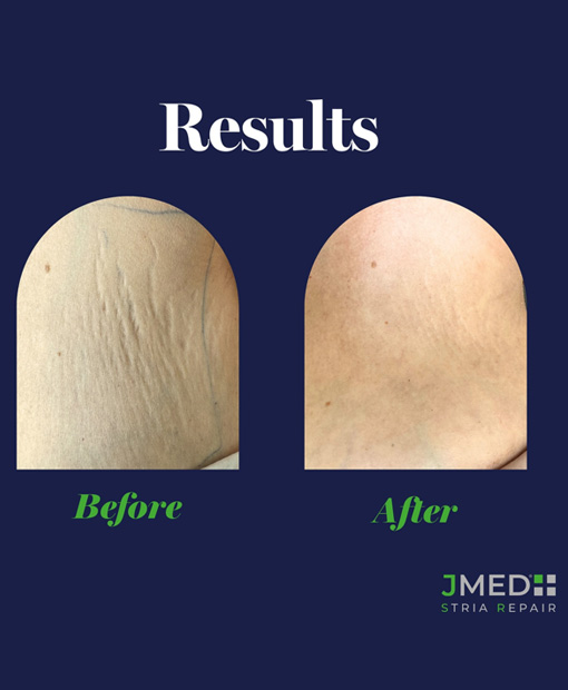 Stretch Mark Removal Treatment Kuwait