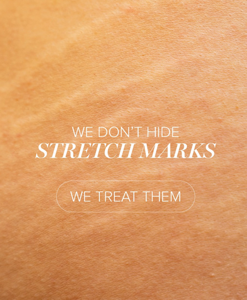 Stretch Marks Removal Expert Kuwait