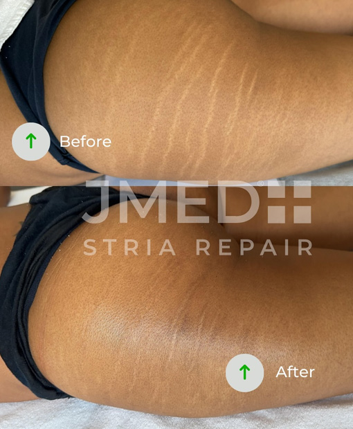 Stretch Mark Removal Clinic In Oman