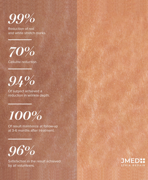 Stretch Marks Removal Expert Doha