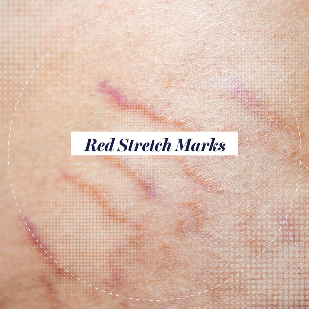 Stretch Mark Removal In Riyadh