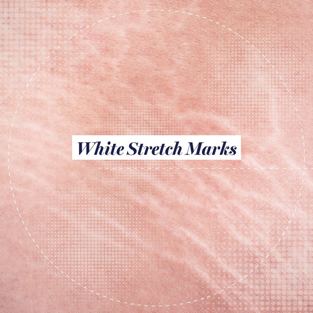 Stretch Marks Treatment Riyadh