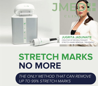 What Is the Best Treatment for Stretch Marks? A Complete Guide What Is the Best Treatment for Stretch Marks? A Complete Guide