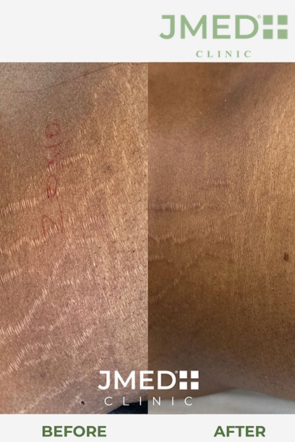 most effective treatment for stretch marks most effective treatment for stretch marks