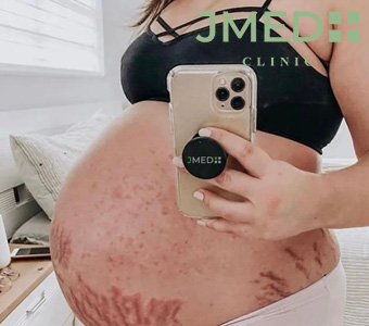 Can You Really Prevent Stretch Marks While Pregnant? Here’s the Truth