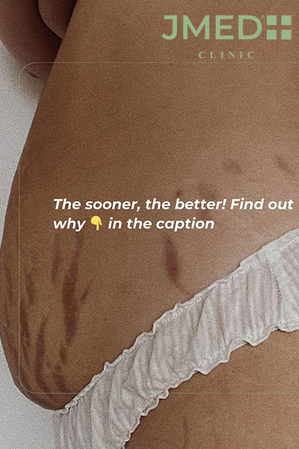 Pregnancy Stretch Marks Removal