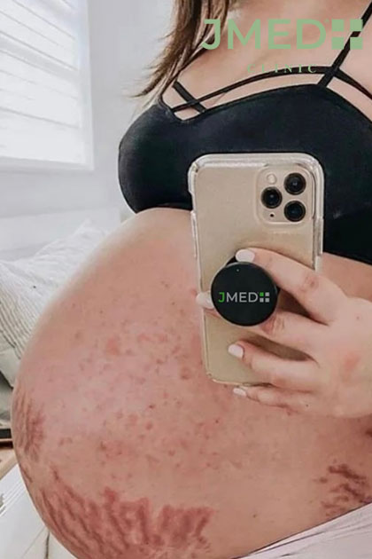 Prevent stretch marks during pregnancy