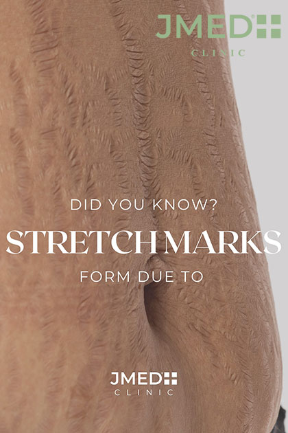 Stretch Marks After Pregnancy in Dubai
