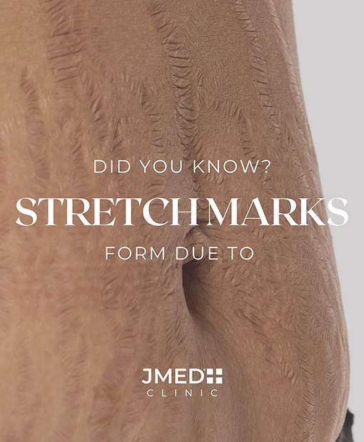 Stretch Marks Removal In Al Barsha Stretch Marks Removal In Al Barsha