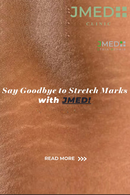 remove my stretch marks permanently