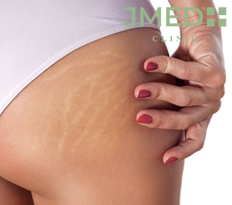 Can Stretch Marks Be Removed Without Surgery?