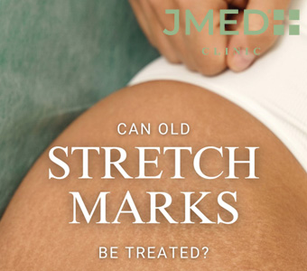How much does it cost to get rid of stretch marks?
