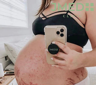 How to treat stretch marks during pregnancy?