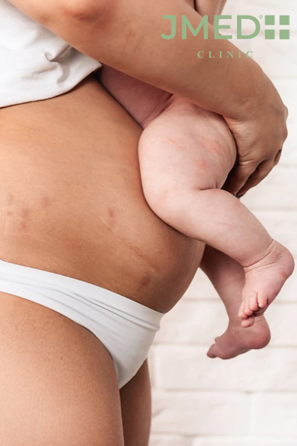 Managing New Stretch Marks During Pregnancy