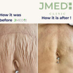 Stretch Mark Recovery: Expert Treatments for Postpartum Skin
