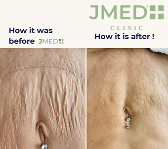 Stretch Mark Recovery: Expert Treatments for Postpartum Skin