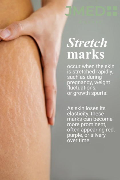 Get rid of stretch marks Get rid of stretch marks