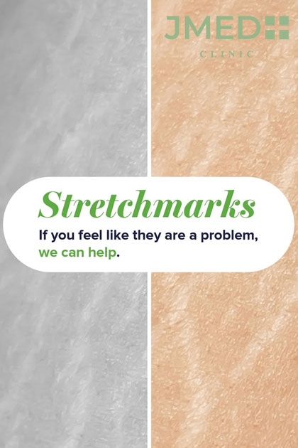 100% Stretch Marks removal in Dubai