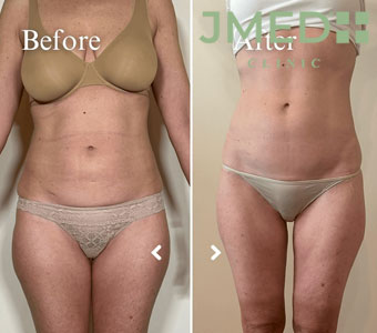 Does body contouring really work