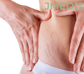 How to Get Rid of Stomach Stretch Marks?