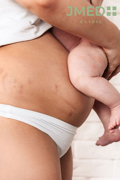 Pregnancy Stretch Marks removal in Dubai