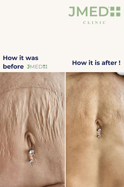 Stretch Marks If I’m Skinny Stretch Marks If I’m Skinny