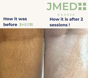 Why Do I Have Stretch Marks If I’m Skinny?