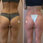 body contouring in Dubai